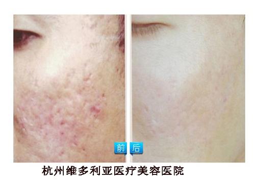 激光祛痘印疼吗-激光祛痘印痘坑疼么,有人做过