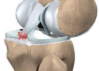 我的脚软组织挫伤-脚软组织挫伤