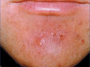 疖痈为什么会反复出现-治疗痈疖的方法，最好是中药的，谢谢 _感人网