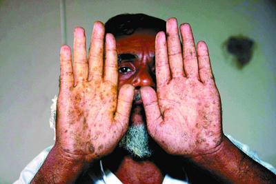 请问轻微砷中毒后人是什么症状?-请问轻微铅中