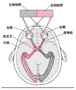 胶质性肿瘤,压迫视神经,在那里能治。-脑部肿瘤压迫视神经