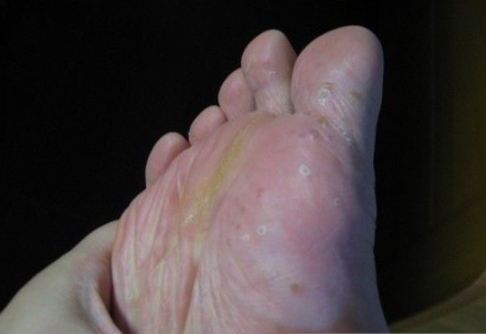 水泡型脚气什么药可以除根-水泡型脚气用什么药