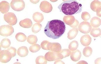 惰性淋巴瘤和慢淋白血病一样吗?-什么是惰性淋巴瘤