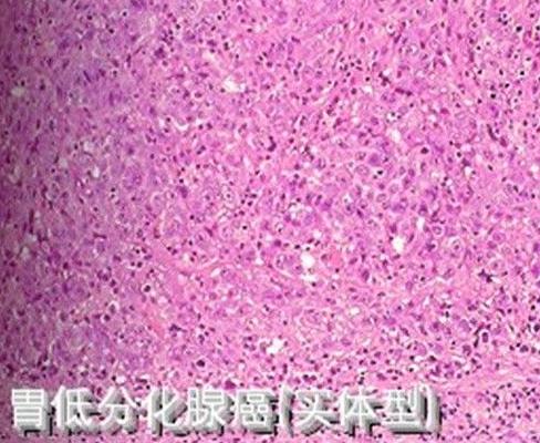 腺癌分化Ⅱ~Ⅲ什么意思?-低分化胃腺癌能活多