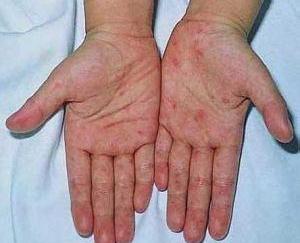 拔罐子之后又皮下出血点是为什么?-老年人手臂