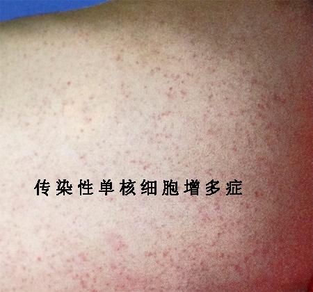 我想知道有关传染性单核细胞增多症的资料-