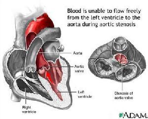 先天性主动脉瓣上狭窄