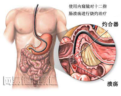 下消化道出血