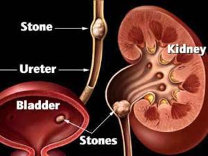 输尿管结石几乎均来自肾脏,而且肾结石比其他任何部位结石更易直接