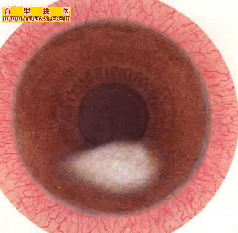 结果形成角膜前粘性白斑或角膜葡萄肿