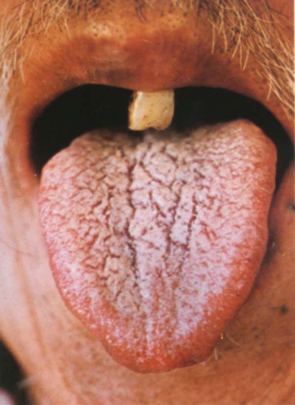其中,肺舌苔白腐,肝痈舌苔紫灰脓腐,胃痈舌苔黄腐.