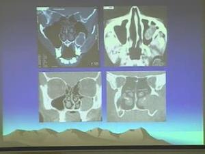 鼻粘膜溃疡患者应暂时脱离铬作业