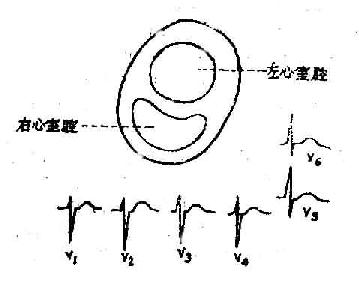 心电轴左偏是什么意思_电轴左偏心电图_匝道