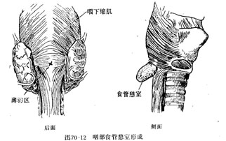 食管中段憩室