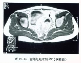 宫角妊娠+-+搜搜百科