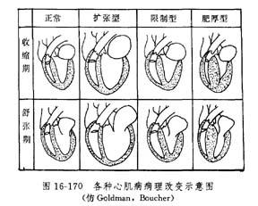 老年人扩张型心肌病