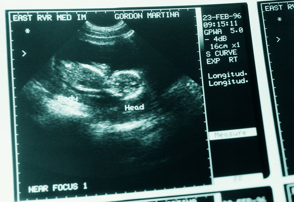 当<em>35岁</em>以上的妇女<em>怀孕</em>时