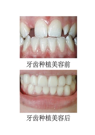 牙齿种植