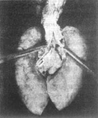 <em>小儿肺结核</em> - 搜搜百科