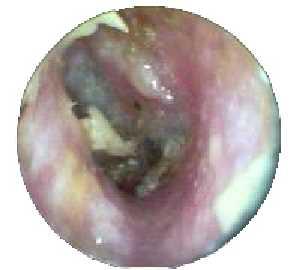 外耳道狭窄及外耳道胆脂瘤必须要做手术吗?