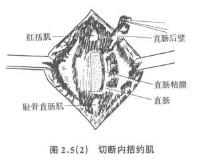 耻骨直肠肌综合征