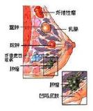 乳腺癌 - 搜搜百科