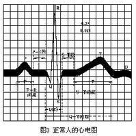 心电图