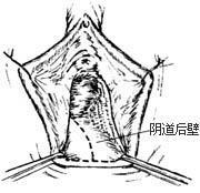 疾病名称   阴道前壁膨出  疾病分类   妇产科  疾病描述   当女性