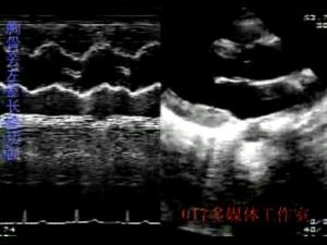超声心动图检查:m型检查显示二尖瓣大瓣曲线