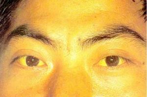 黄疸（皮肤和眼睛发黄）(黄疸皮肤和血液差别大)