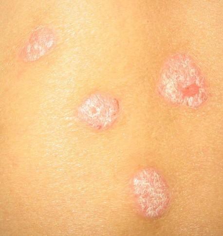  银屑病 - 搜搜百科