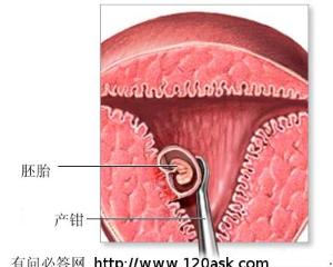 超导无痛人流+-+搜搜伯科