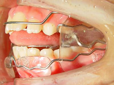 固定义齿- 搜搜百科