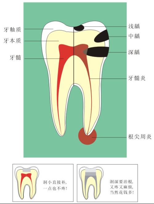 极面龋齿