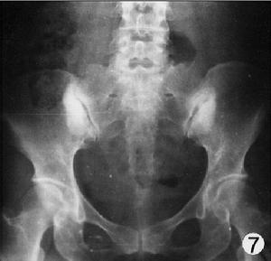 左侧髂骨致密性骨炎会引起什么症状