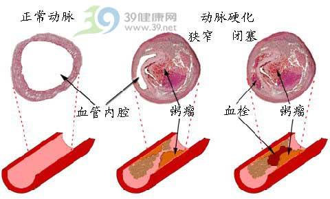 可治冠心病+心绞痛+心肌梗塞