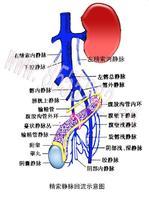 精索静脉曲张