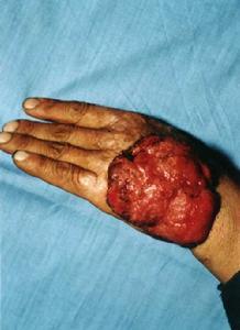 inoma)全称鳞状细胞癌