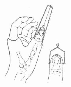 第一掌骨基底部骨折脱位