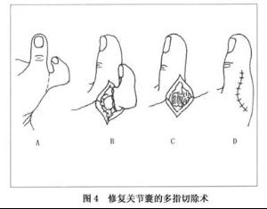 对简单型多指特别是尺侧多指出生后3～6个月手术较好;对有严重畸形