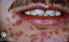 1)前驱症状:二期梅毒患者在皮肤发疹前有时有