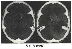 颅咽管瘤