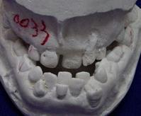 最常见的阻生牙是下颌第三磨牙