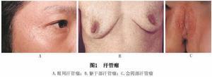 也可见于胸腹乳房和外阴部