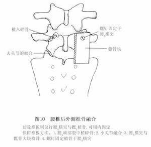 无脊柱滑脱的腰椎峡部裂ct漏诊分析