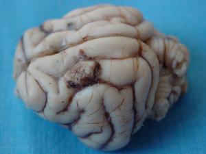 脑外伤所致精神障碍