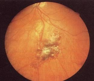 视网膜海绵状血管瘤