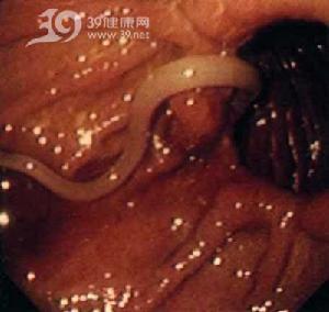 蛔虫性急性胰腺炎