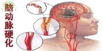 包括医学上常常提到的脑动脉粥样硬化(大,中动脉),小动脉硬化,微小