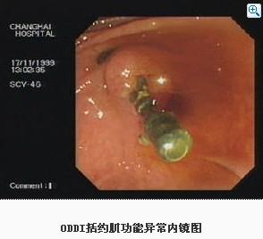 ODDI括约肌功能异常